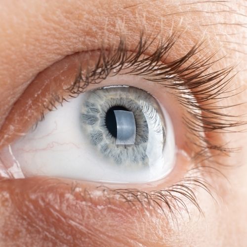Corneal Issues