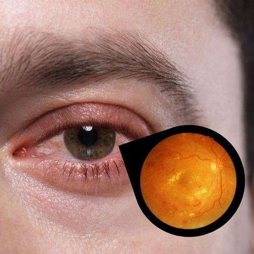 Diabetic Retinopathy