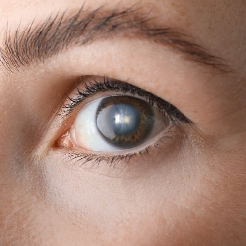 Glaucoma
