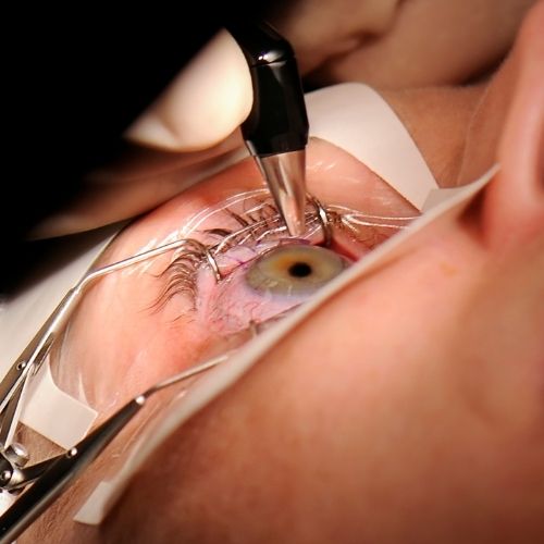 LASIK