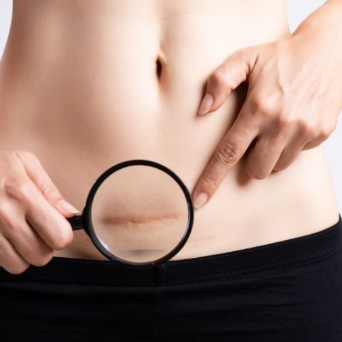 Cesarean section