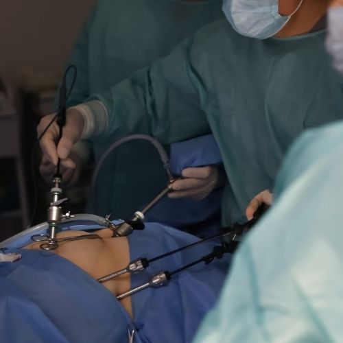Laparoscopy