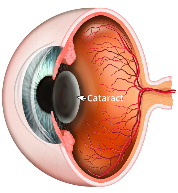Cataract Treatment in Sion, Mumbai Dr Rahul Surti – Surti Shaurya’s Eye Clinic
