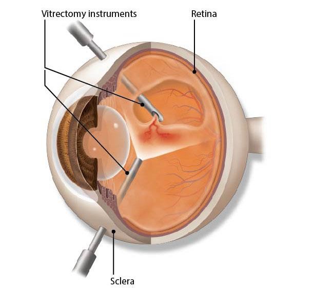 Retina Repair Surgery In Mumbai Vitrectomy By Dr Rahul Surti Sion Retina Repair Surgery In Mumbai Vitrectomy By Dr Rahul Surti Sion