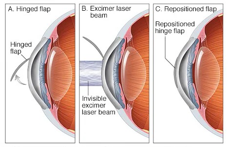 Best LASIK surgeon in Sion Mumbai