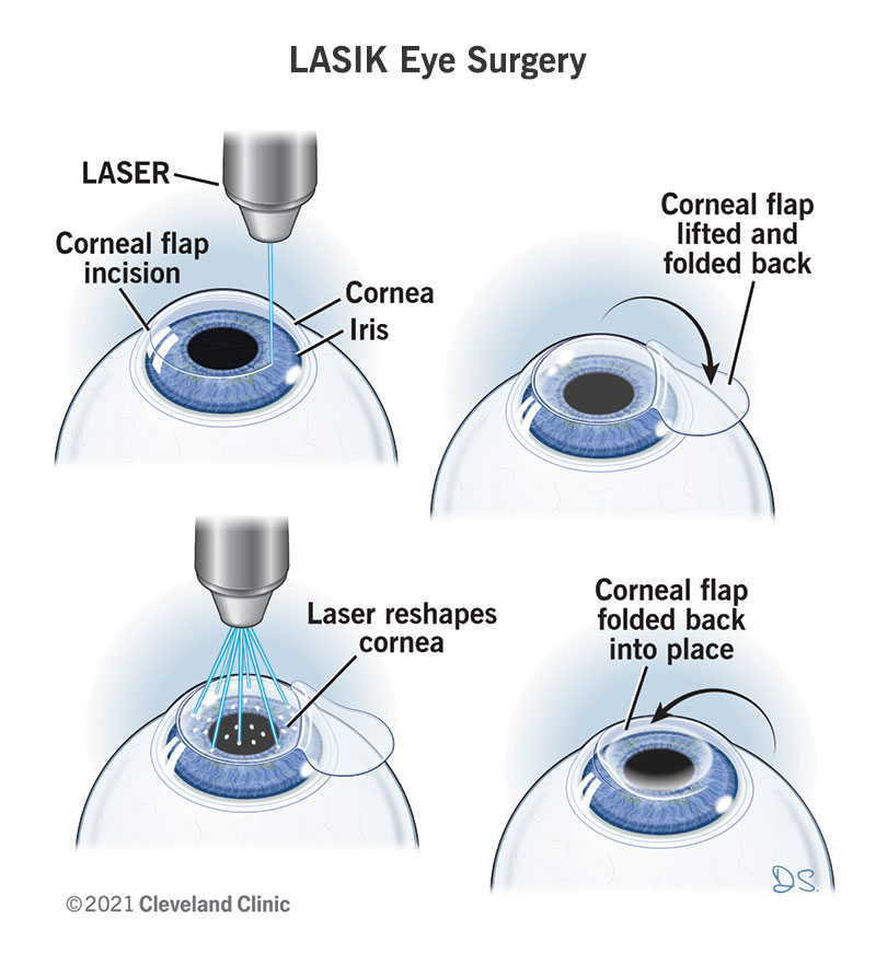 LASIK Surgery in Sion Mumbai
