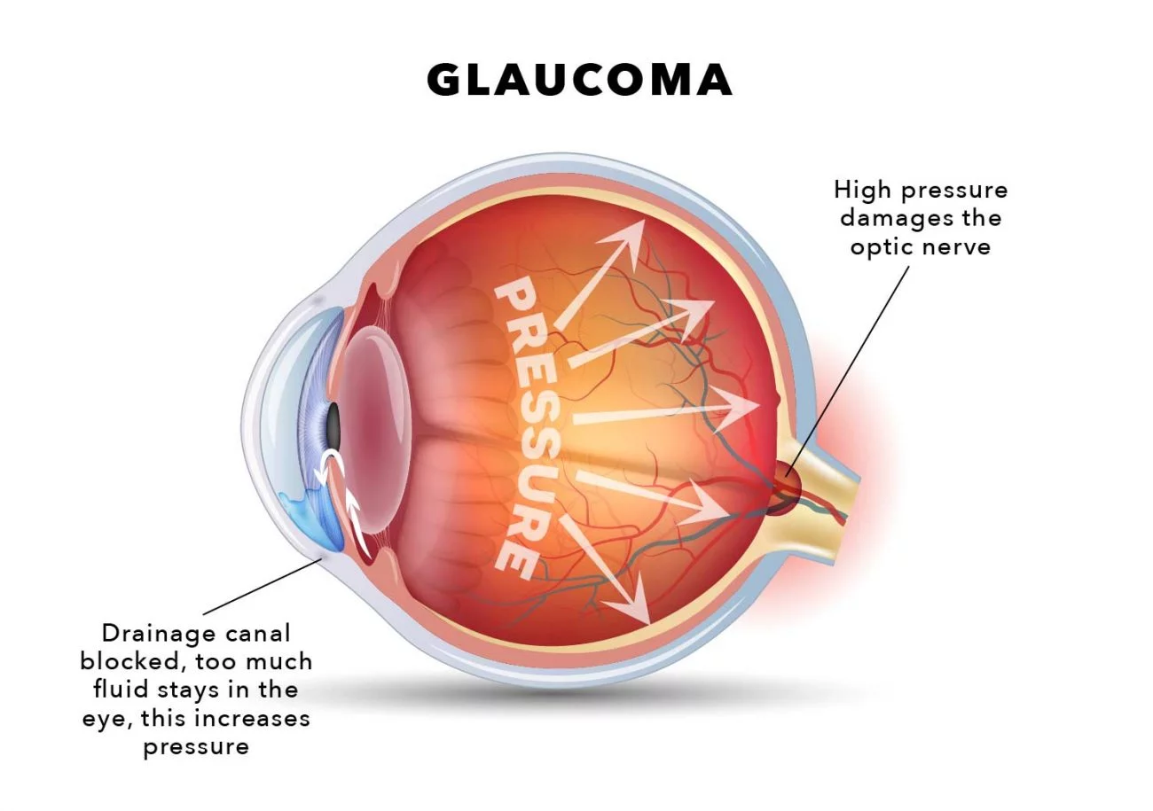 Glaucoma surgery in Sion