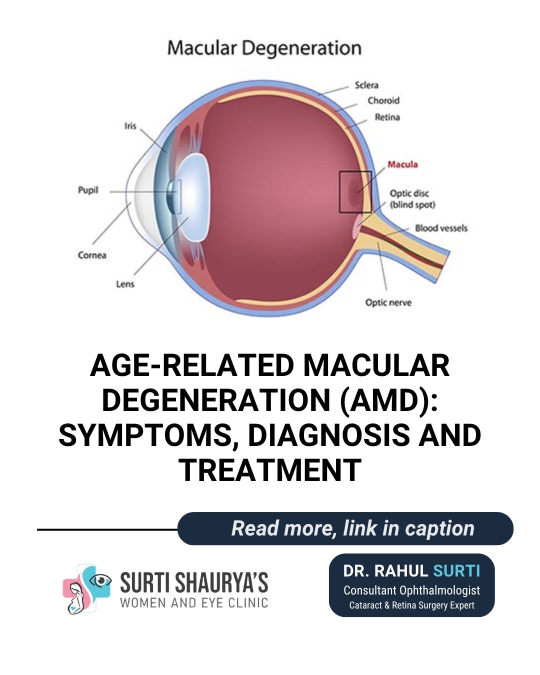 Age-Related Macular Degeneration Treatment in Sion - Dr Rahul Surti